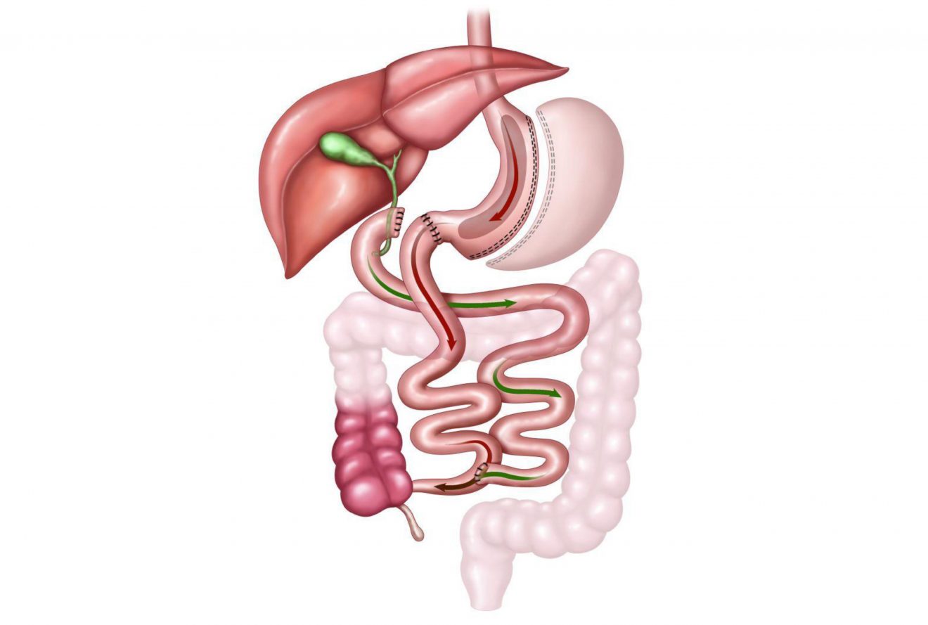 Бариатрия. Билиопанкреатическое шунтирование желудка что это. Билиопанкреатическое шунтирование желудка этапы операции.
