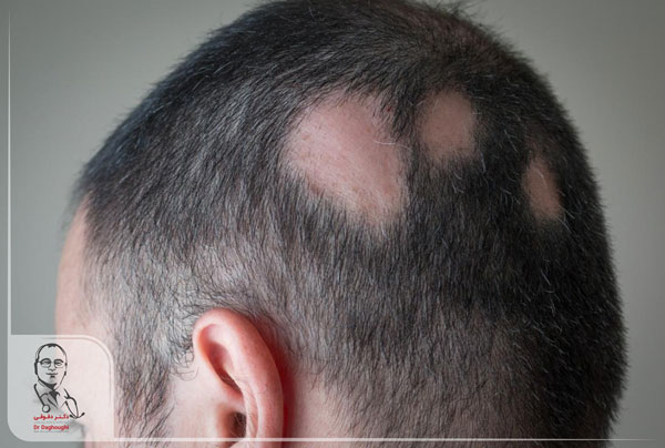 ریزش موی سکه ای یا alopecia areata
