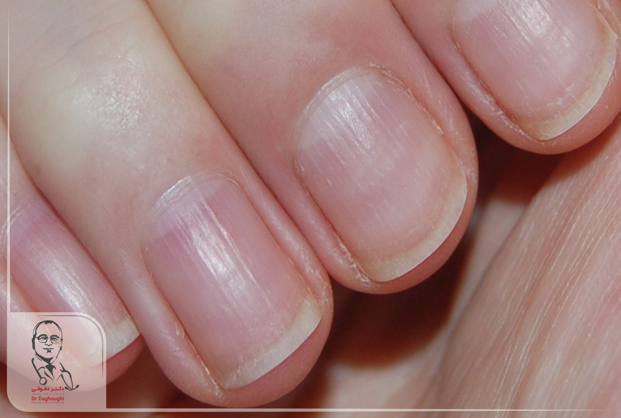 Полоски на ногтях причины вертикальные у женщин. Продольные полосы на ногтях.